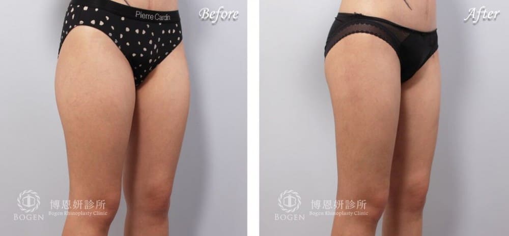 大小腿抽脂,大腿抽脂,小腿抽脂,馬鞍肉抽脂,抽脂手術,李岳樺醫師,博恩妍